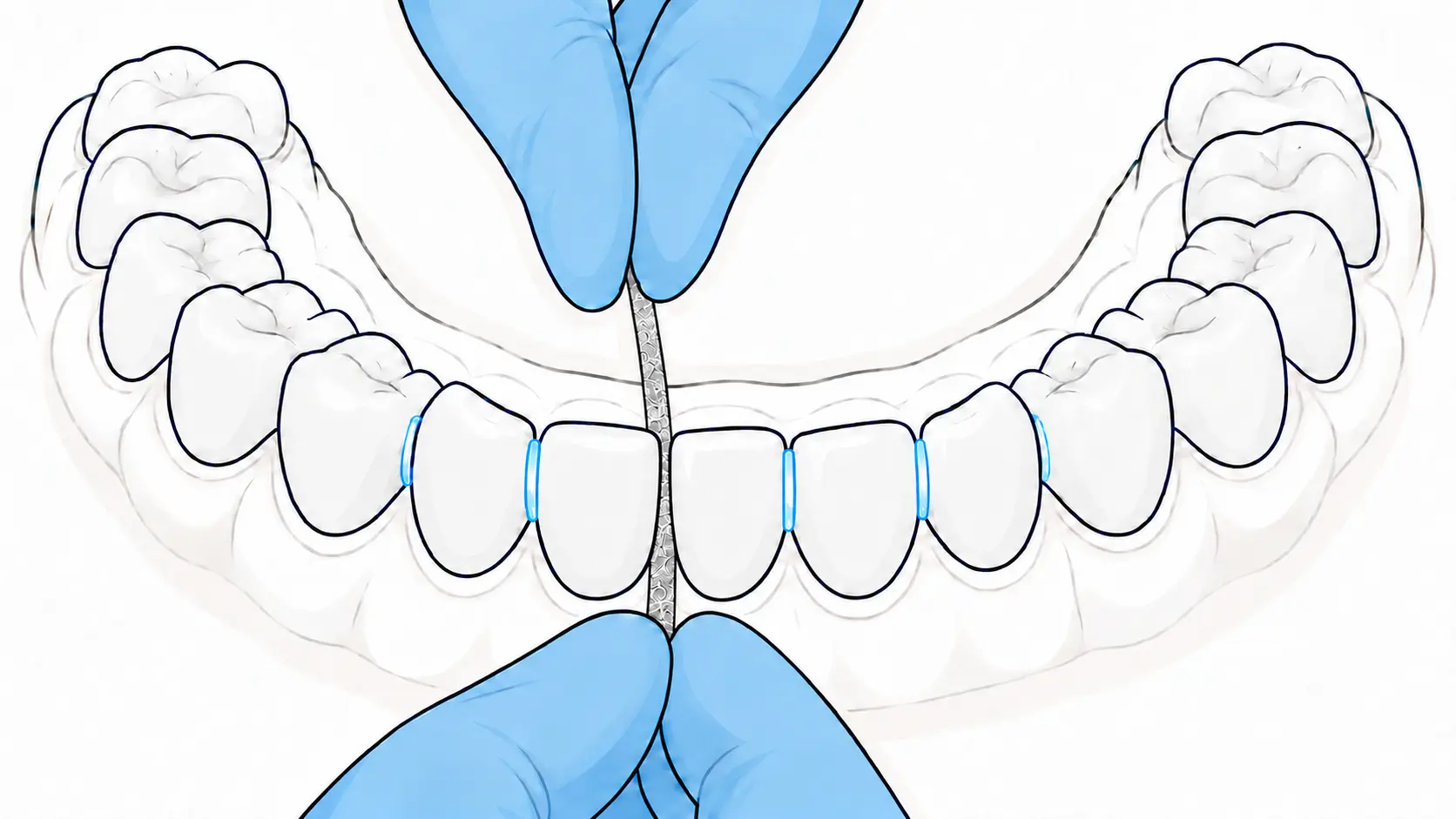 Illustration: Interproximal enamel reduction