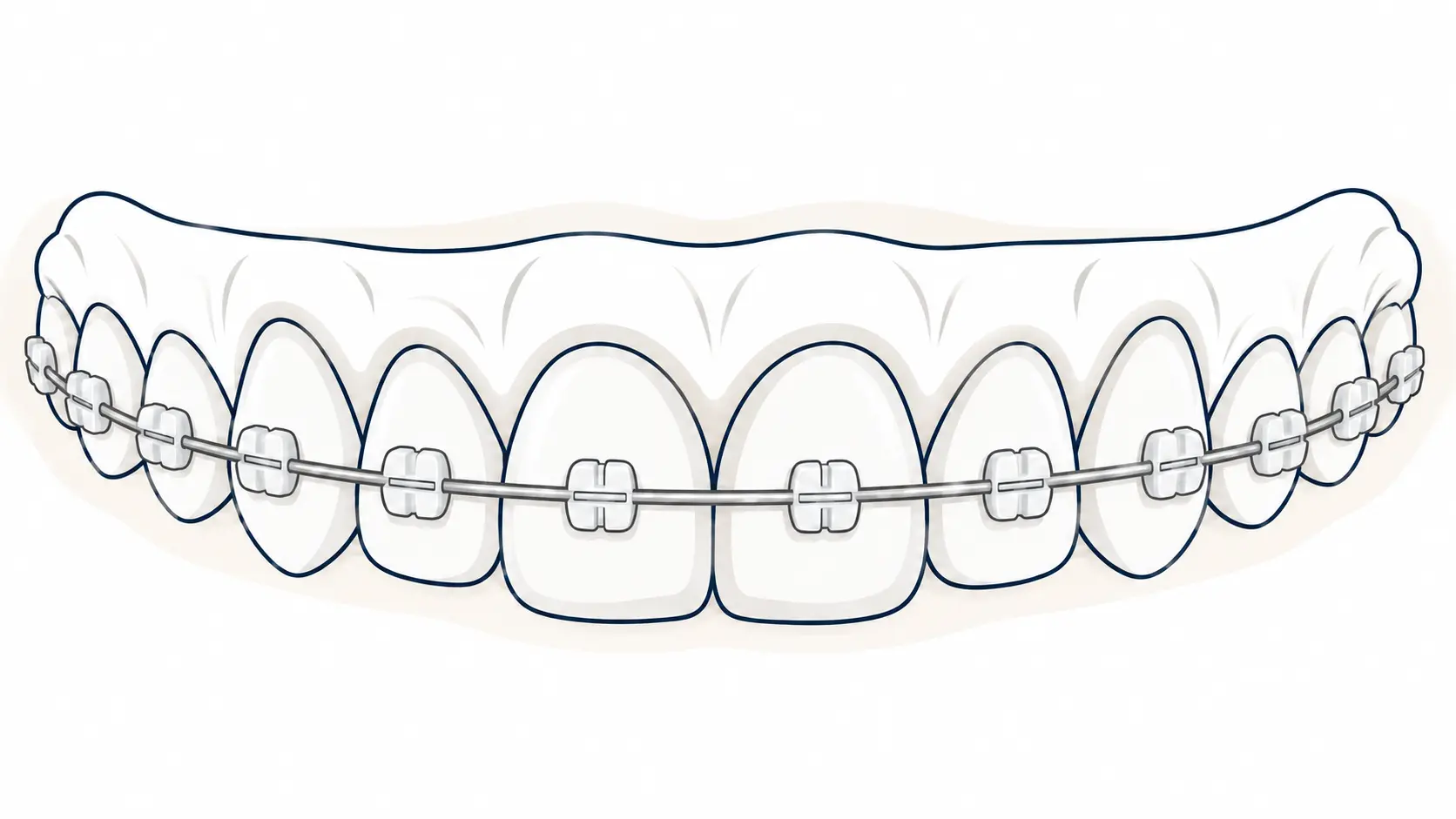 Illustration: Ceramic brackets