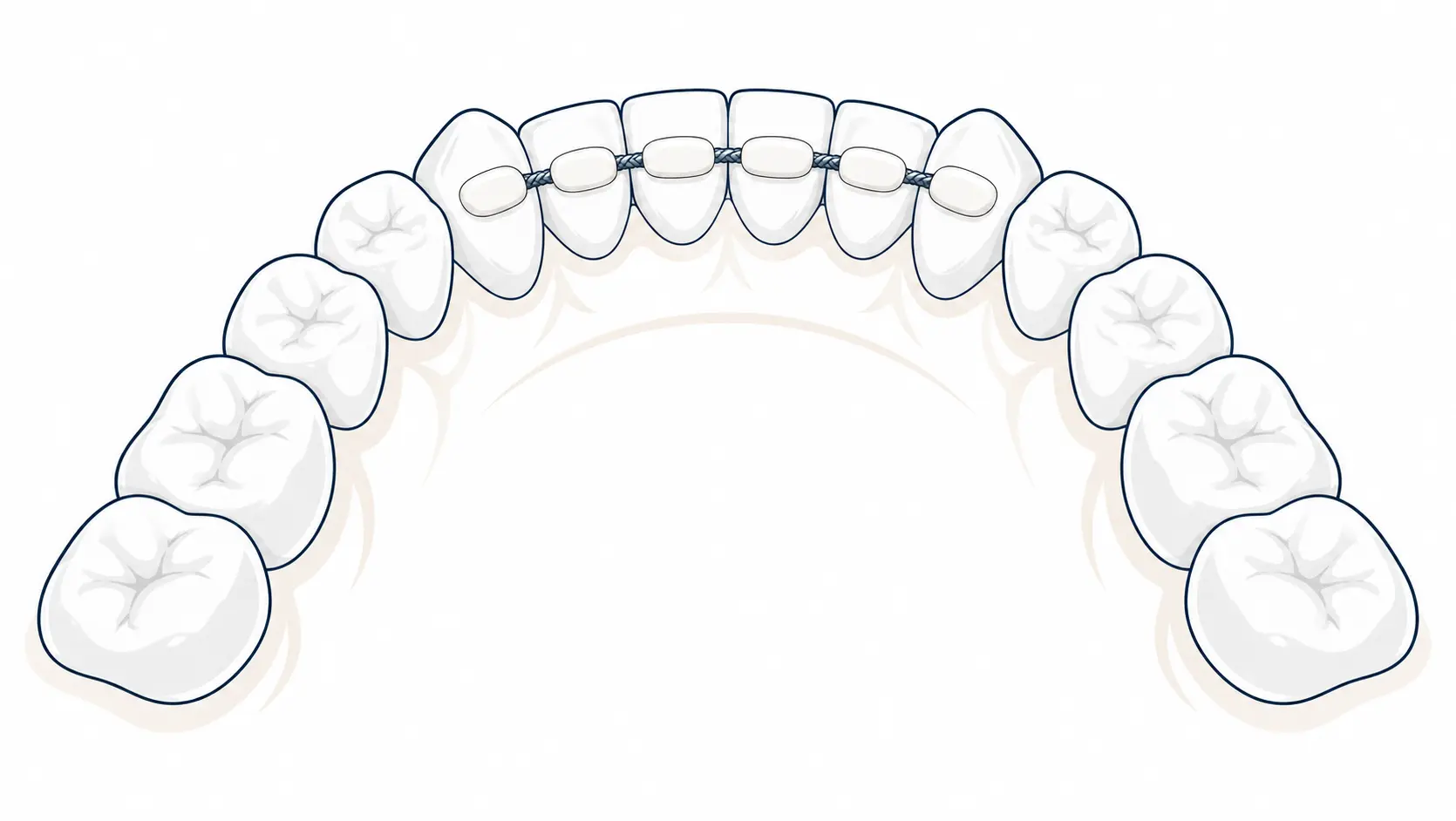 Illustration: Retainers