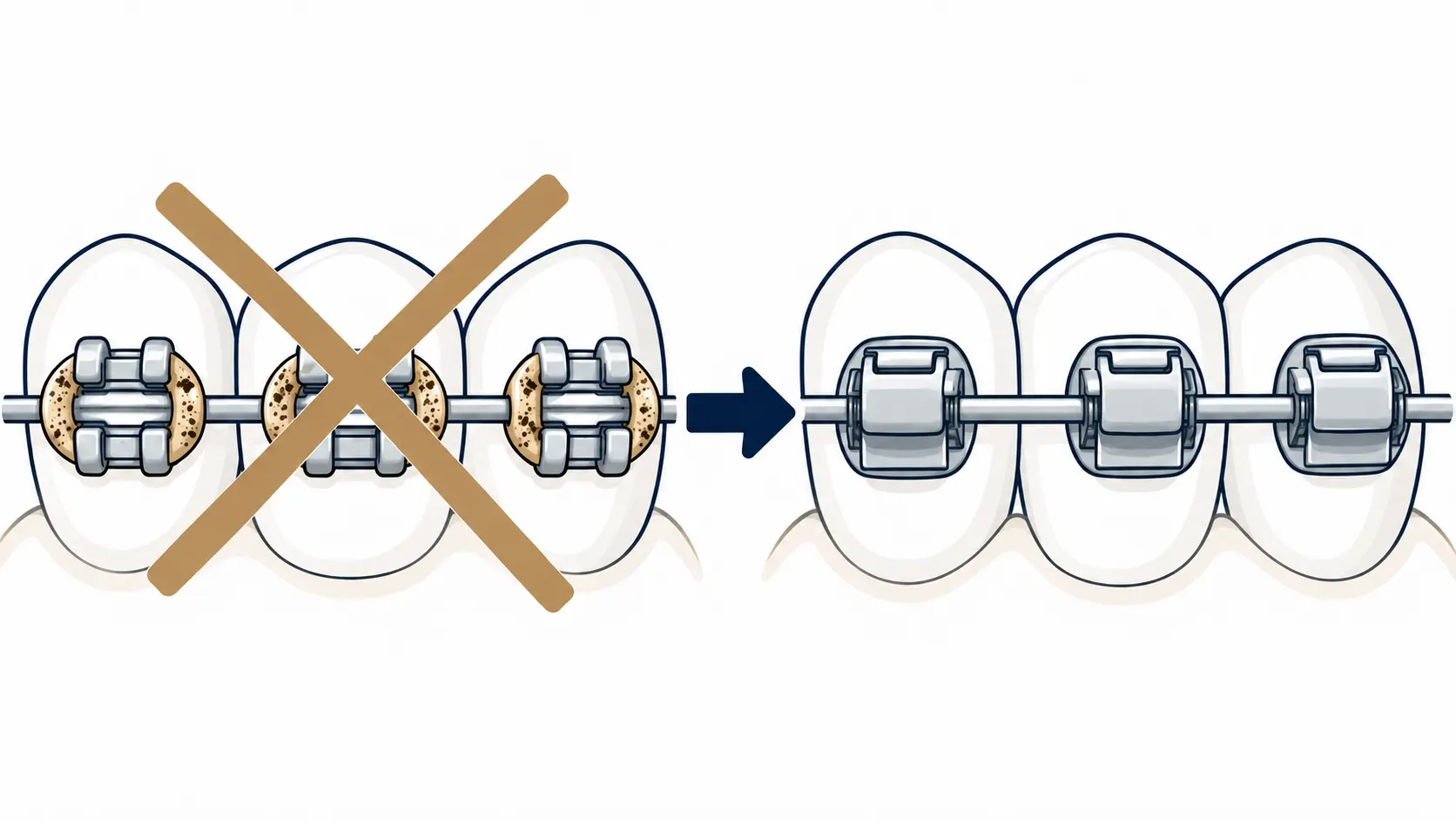 Illustration: Self-ligating brackets