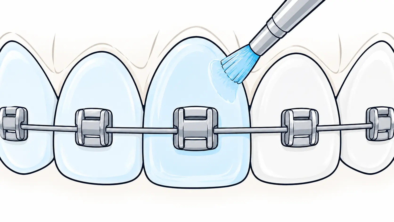 Illustration: Protective enamel sealant
